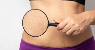 Causes of stretch marks